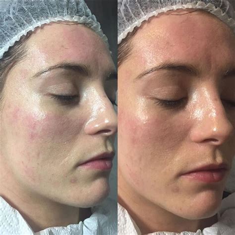 Are there risks associated with "BB Glow" Microneedling