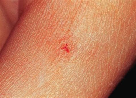 A triangular wound can possibly be sutured, depending on many considerations regarding the wound including its type, condition, location, size, shape, depth, cleanliness vs ….