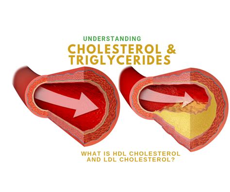 Are triglycerides cholesterol. .  The combination of high levels of trigly...