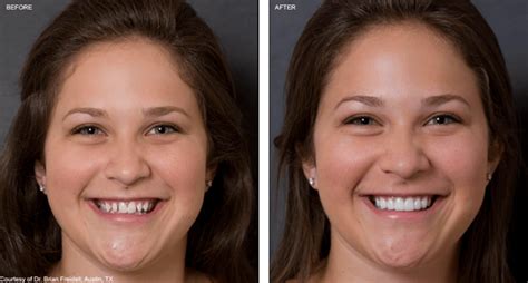 Though the veneer may not change color, natural teeth may become stained and require whitening to match the veneer. Veneers may need to be replaced every 10-20 years, or earlier if there is a chip or crack (veneers usually can't be repaired) Prohibitive cost - composite veneers can cost from $400-$2,500 per tooth; porcelain veneers generally .... 