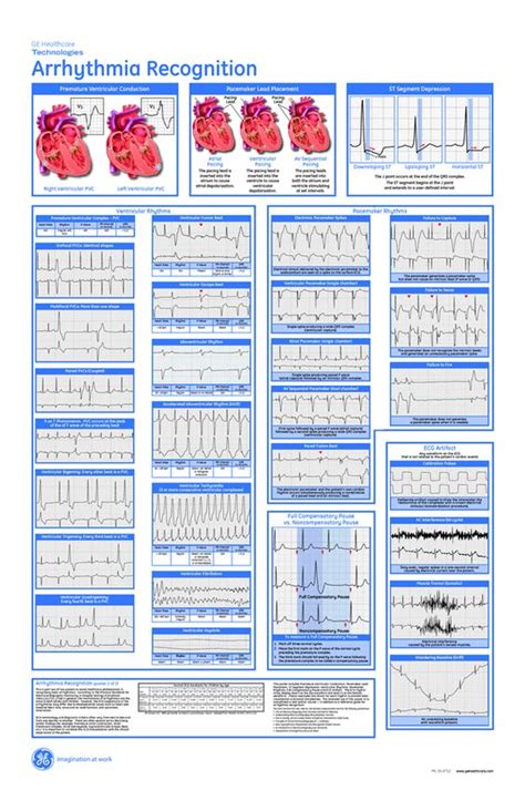 Arrhythmia Recognition A day in the life of a Nurse... Pinterest