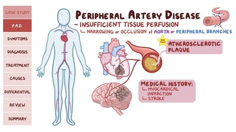 Arterial disease Osmosis