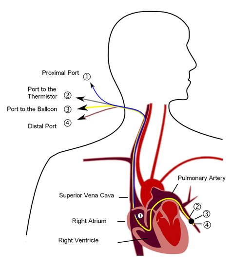 Arterial line - Wikipedia