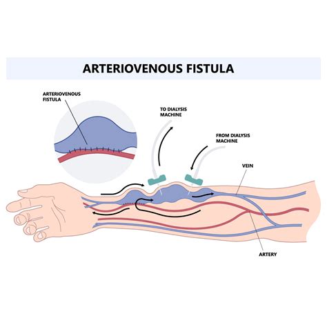 Arteriovenous Fistula - Heart and Blood Vessel Disorders