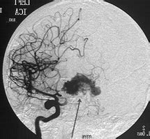 Arteriovenous Malformation (AVM) - University of Florida