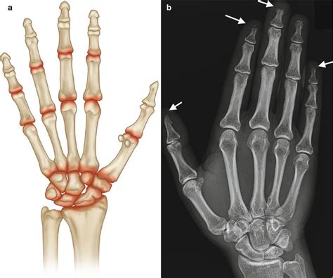 Arthritis: A Diagnostic Approach Radiology Key