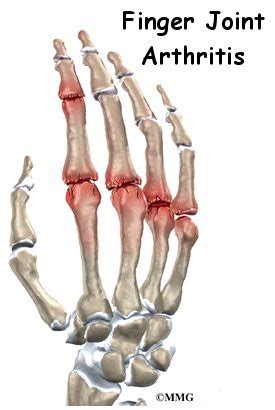 Arthritis of the Finger Joints - Orthogate