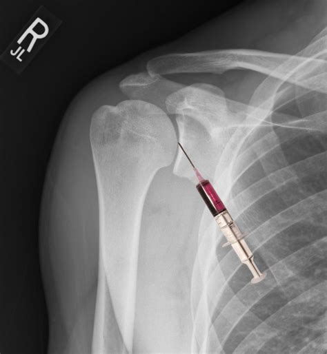 Arthrocentesis Article - StatPearls