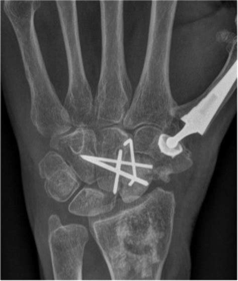 Arthrodesis of the Trapeziometacarpal Joint - deepdyve.com