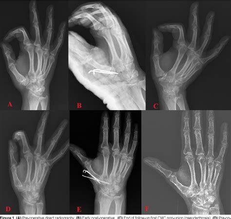 Arthrodesis of the first carpometacarpal joint