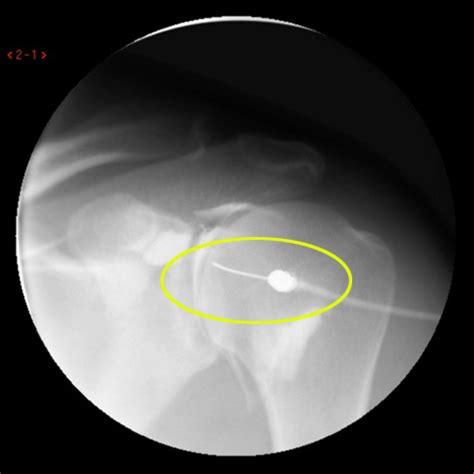 Arthrogram Cedars Sinai