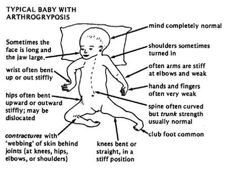 Arthrogryposis multiplex congenita (AMC) Erfelijkheid.nl