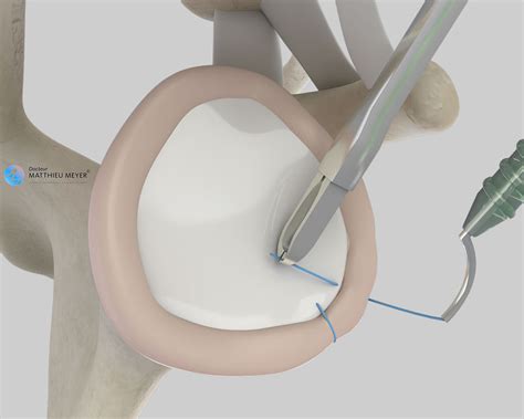 Arthroscopic Bankart Repair - Boston Sports Medicine