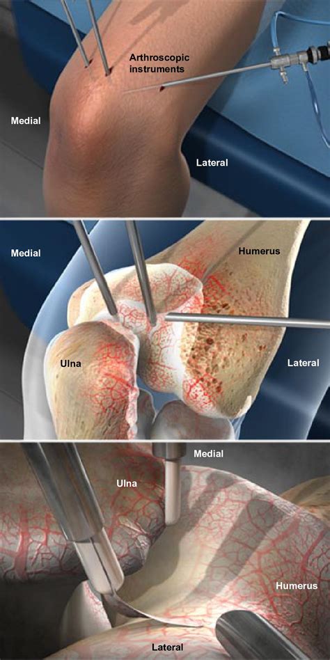 Arthroscopic Meniscectomy with Debridement and …