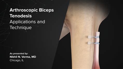 Arthroscopic biceps tenodesis video. .  We present our technique for arthrosc...