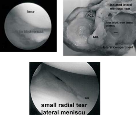 Arthroscopy of the Stifle. Traditional & Nontraditional Portal Sites