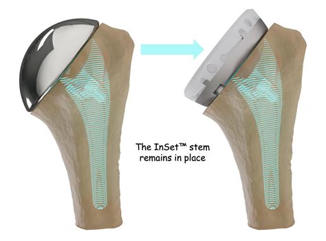 Articles with Shoulder Innovations