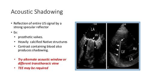 Artifacts in echocardiography - SlideShare