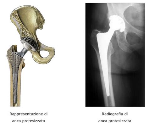 Artroplastica totale dell'anca una guida completa alla riabilitazione. - Study guide for the bronx masquerade.
