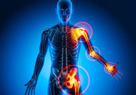 Artrose (osteoartrite): o que é, sintomas e tratamento - MD.Saúde