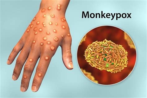 As monkeypox spreads in South Florida, experts have advice on