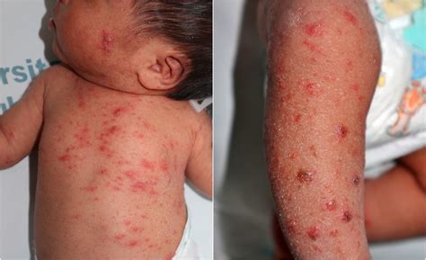 Ask the Pediatrician: What is scabies?