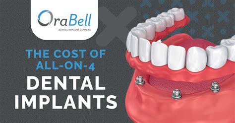 Aspen dental all on 4 cost. All-On-4 Dental Implants Cost From $12,000 To $25,000 Per Arch. If you happen to lose multiple teeth for some reason and feel embarrassed to smile, all-on-4 dental implants might be a solution. All-on-4 dental implants are a very popular and relatively affordable option to replace multiple missing teeth. Here we will try to help you understand ... 