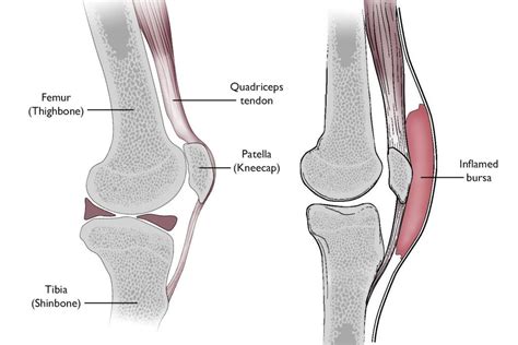 Assessment Diagnosis Pre-patellar bursitis CKS NICE