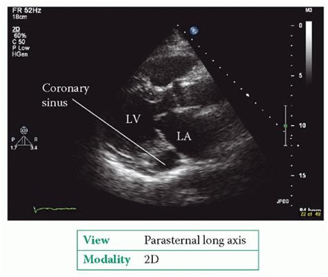 Assessment of Cardiac Masses Thoracic Key