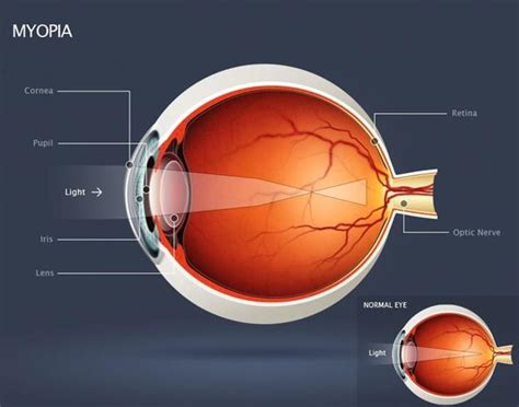 Associations of high myopia in childhood - PubMed