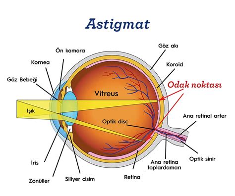 Astigmat ve göz tembelliği