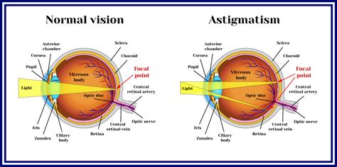 Astigmatism - Prevent Blindness