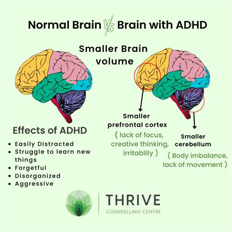 At what age do ADHD brains fully develop