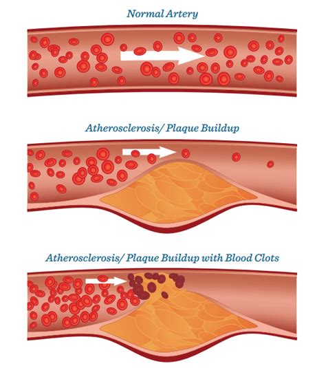 Atherosclerosis Heart and Stroke Foundation