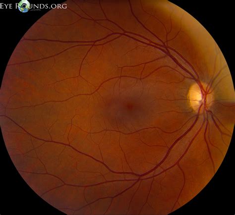 Atlas Entry - Cytomegalovirus (CMV) Retinitis