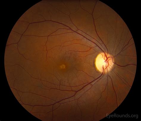 Atlas Entry Pattern dystrophy