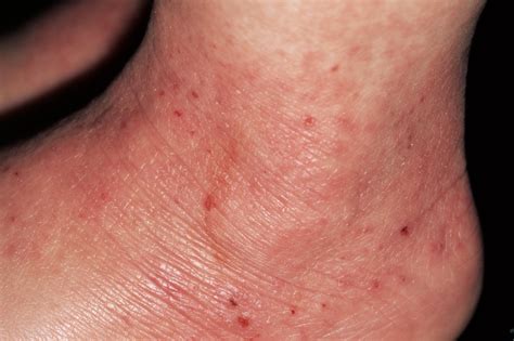 Atopic Eczema