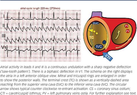 Atypical atrial flutters - PubMed