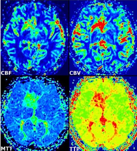 Atypical developmental venous anomaly associated with contrast ...