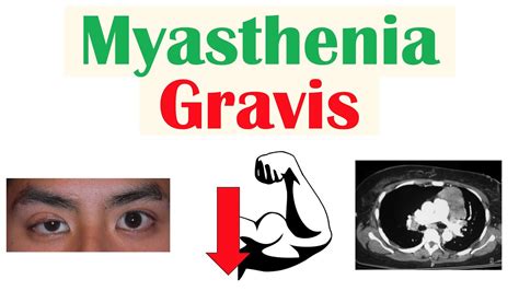 Jun 18, 2021 · Myasthenia gravis is a neuromuscular autoimmune disease that results in skeletal muscle weakness that worsens after periods of activity and improves after rest. Myasthenia gravis means &#x201c;grave (serious), muscle weakness.&#x201d; Although not completely curable, it can be managed well with a relatively high quality of life and expectancy. In myasthenia gravis, antibodies against the ... . 