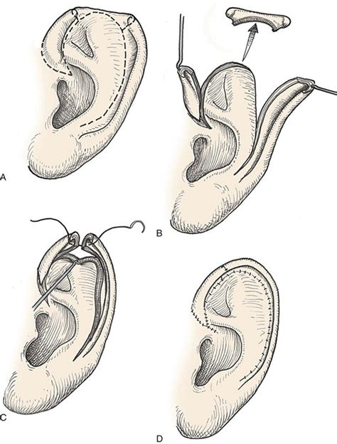 Auricle Plastic Surgery Key