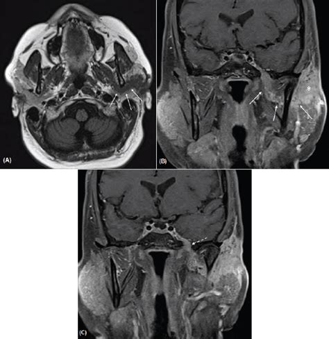 Auriculotemporal nerve Radiology Reference Article