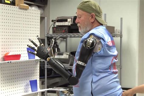 Austin-based startup revolutionizing how amputees control prosthetic limbs