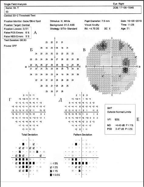 Automated Perimetry: Visual Field Deficits in …