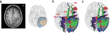 Automatic Removal of False Connections in Diffusion MRI