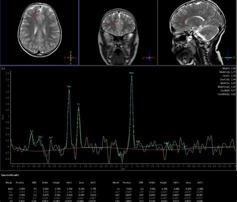 Autosomal recessive spastic ataxia of Charlevoix-Saguenay …