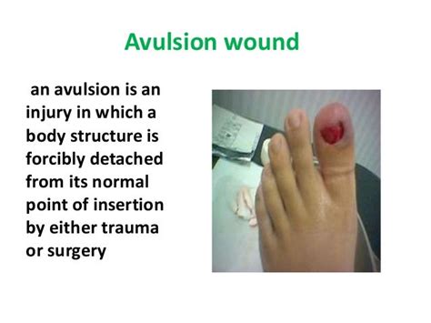 Avulsion in Tamil - Translate.com