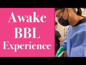 Awake bbl. Awake BBL performed with Precision lipoSCULPTing and safe gentle fat transfer to the Buttocks. Brazilian Butt Lift 