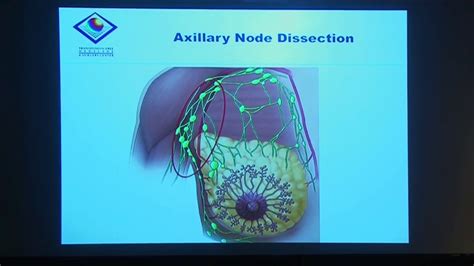 Axillary lymph node dissection vs sentinel biopsy only …