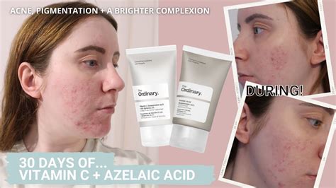Azelaic acid and vitamin c. The short answer is: yes! The two ingredients can be used together to achieve even better results. Azelaic acid is known for its anti-inflammatory properties, while Vitamin C is a powerful antioxidant that can help brighten the skin. When used together, they can help improve the skin’s overall complexion. 